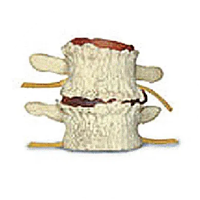 Spine Phase 3