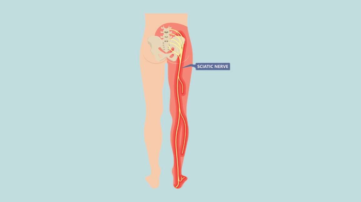 Managing Sciatica: Best Treatments for Long-Term Relief